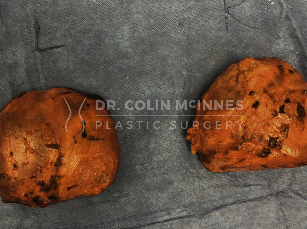 en-bloc-capsulectomy-001